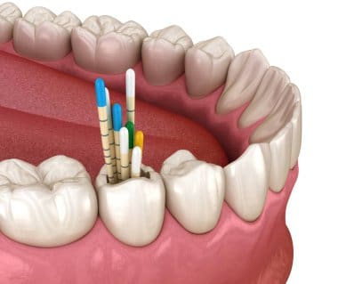 Periodontal Gum Disease for Bad Breath: Fight Odor at the Source